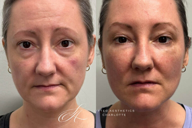 Full facial balancing (healed): dermal fillers and neurotoxin
